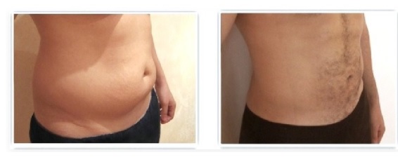 abdominoplastie homme avant apres