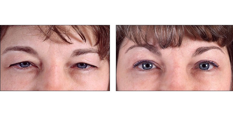 blepharoplastie 