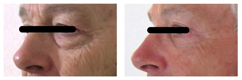 blepharoplastie homme avant apres