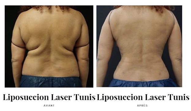 Liposuccion Laser photos d'avant et après