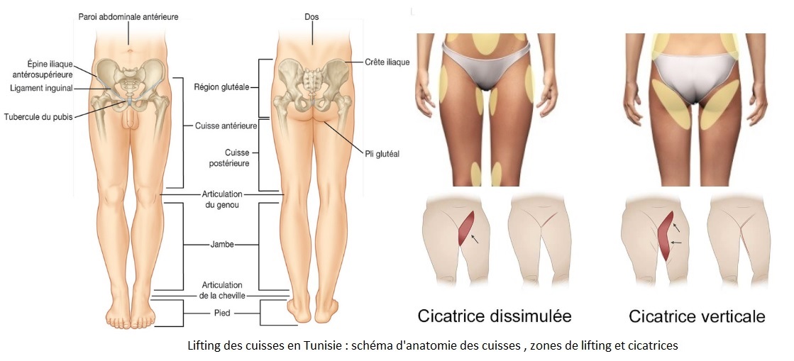 Lifting cuisses : retendre peau distendue entrejambe pour pas cher