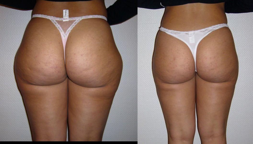 Photos d'avant et après liposuccion hanches et cuisses 