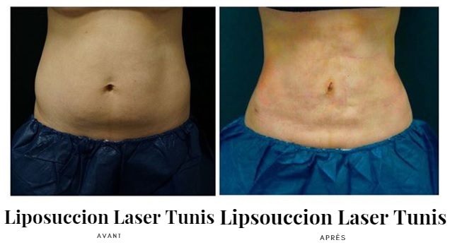 Liposuccion Laser photos d'avant et après lipo ventre