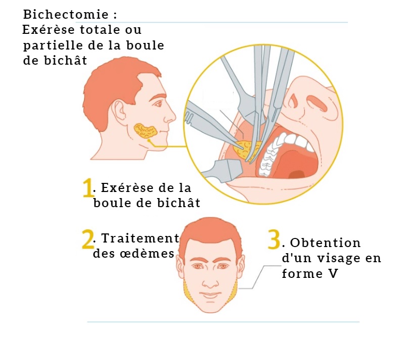 Bichectomie Tunisie