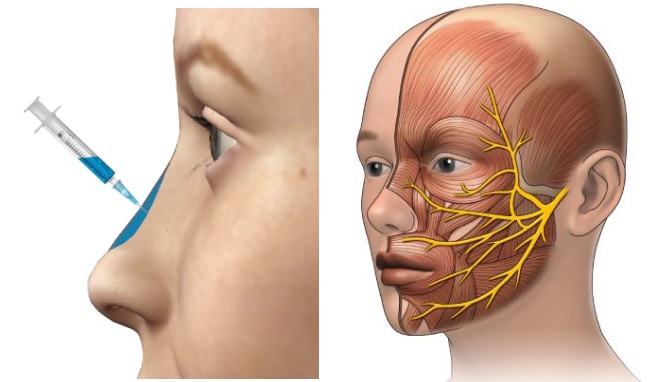 rhinoplastie medicale 