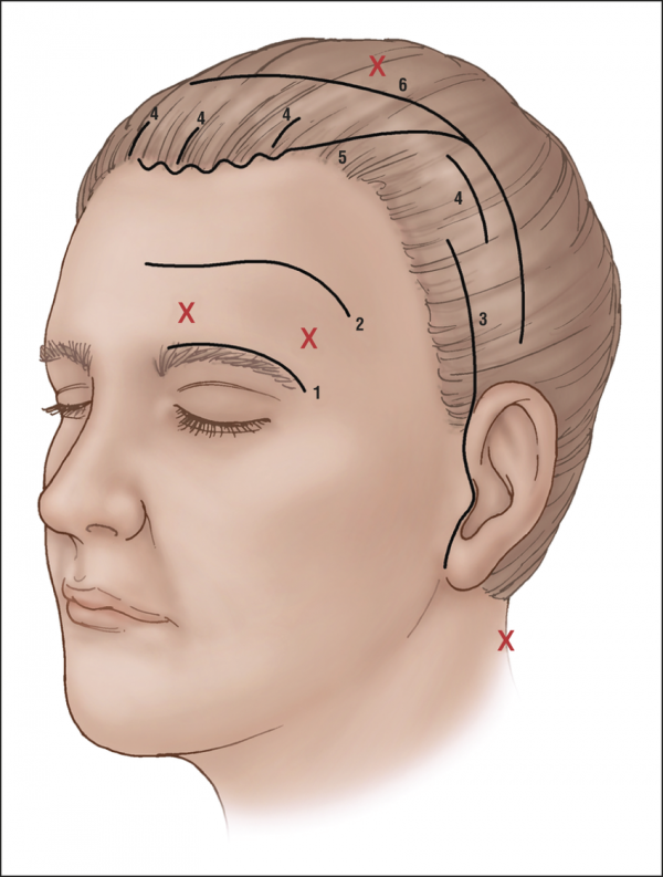 lifting frontal endoscopique Turquie