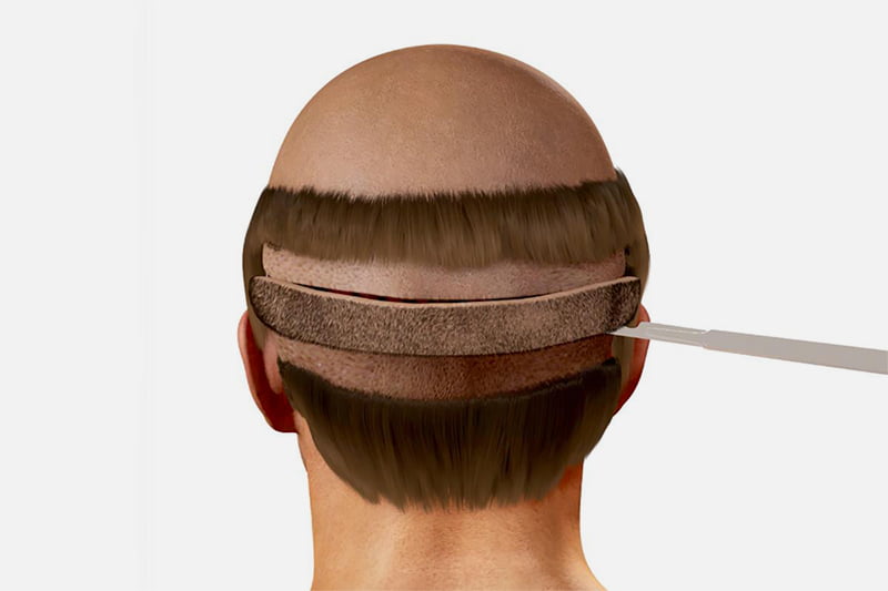 greffe cheveux