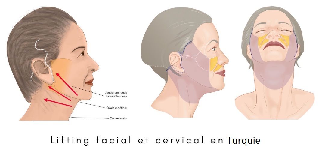 Lifting visage et cou