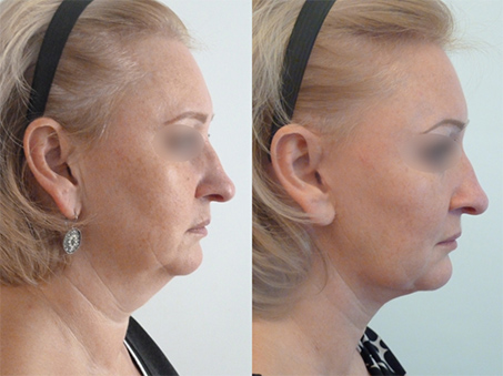 Lipofilling visage