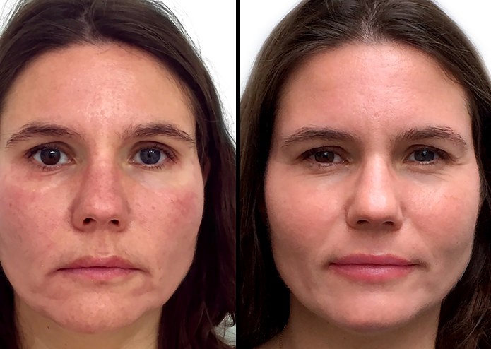 Lipofilling visage 