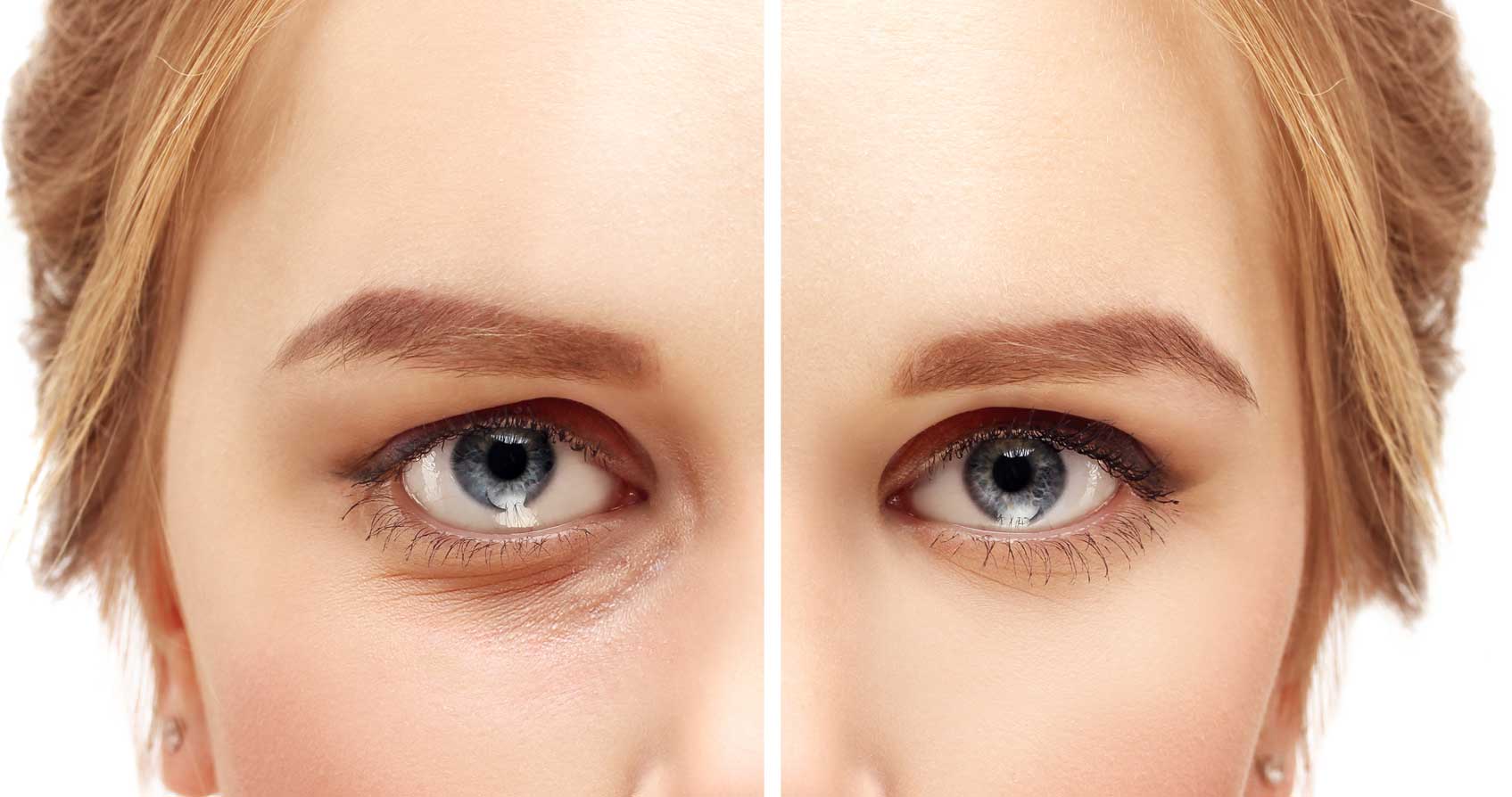 Blepharoplastie Laser Geneve