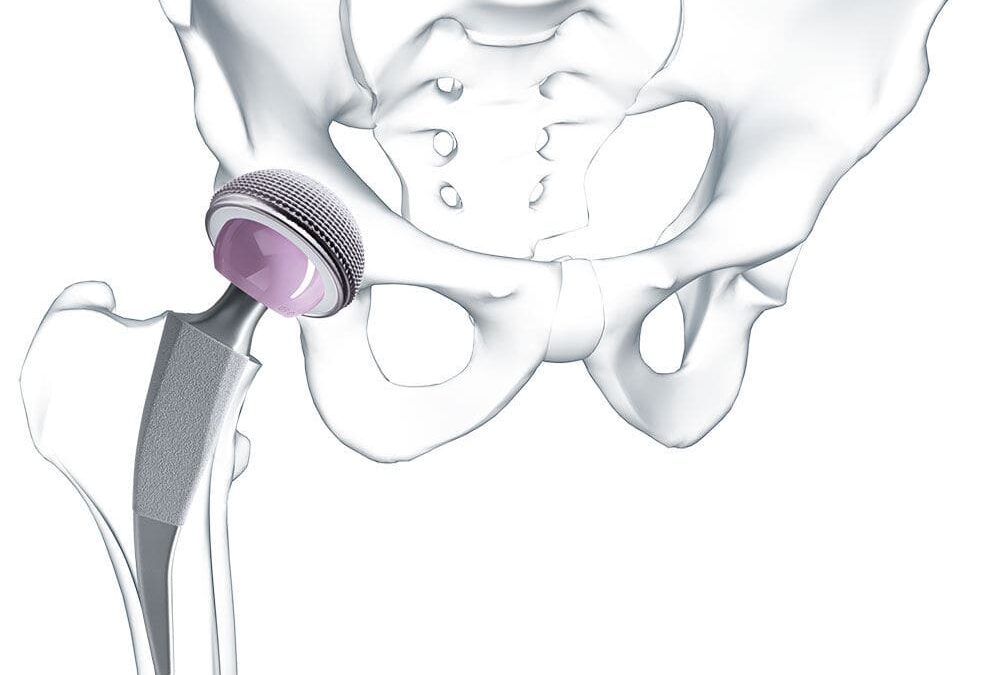 Qu’est-ce qu’une endoprothèse de hanche et combien de types de prothèses existe-t-il ?