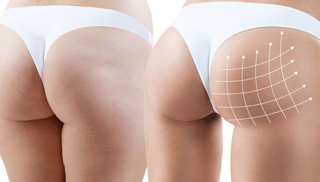 Smart BBL par le Dr Youssef Gam : l&rsquo;évolution du Brazilian Butt Lift grâce au guidage échographique